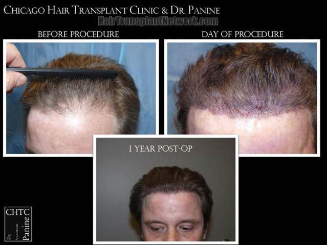 Hair restoration procedure before and after results