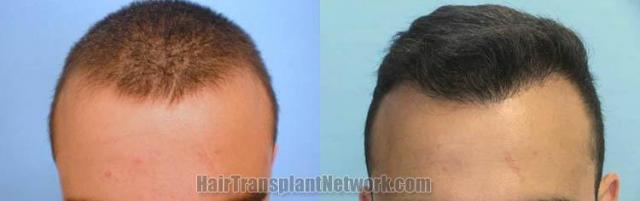 Hair transplantation surgery before and after photos