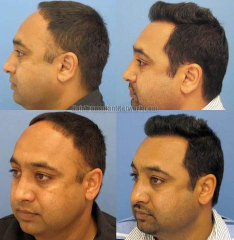 Hair restoration procedure before and after pictures