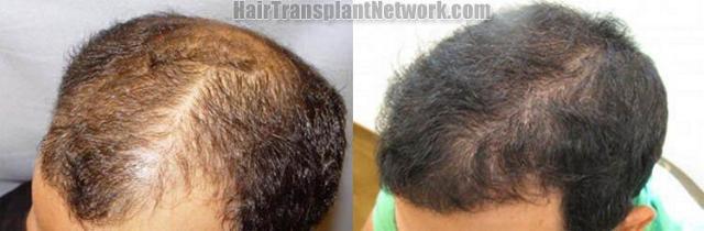 Hair transplant photos before and after viewed from the back