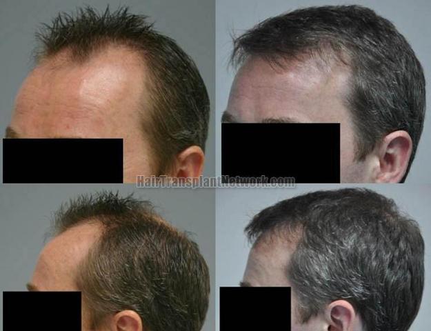 Hair transplantation surgery before and after images