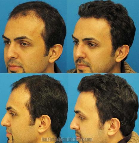 Hair transplantation surgery before and after pictures