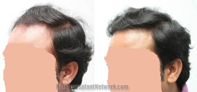 Hair transplantation surgery before and after photos