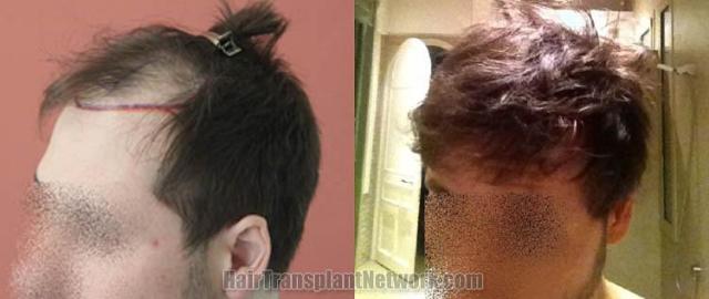 Hair restoration procedure before and after pictures