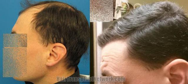 Hair restoration procedure before and after pictures