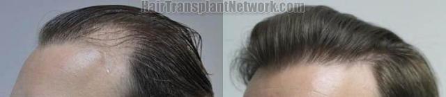 Hair transplantation surgery before and after pictures