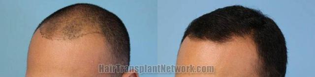 Hair transplantation surgery before and after images