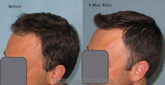 Hair restoration procedure before and after pictures