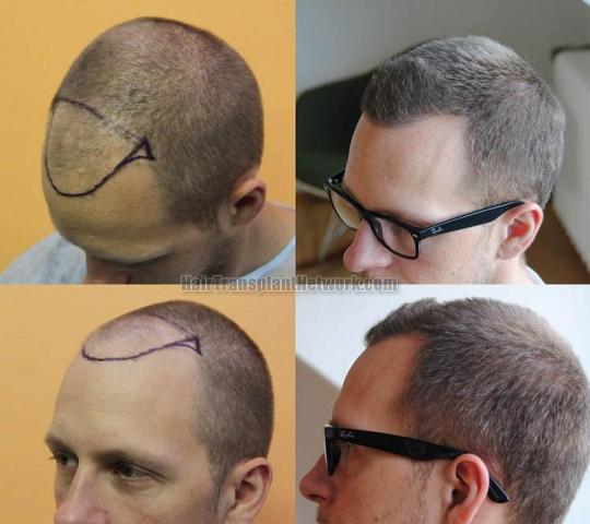 Hair transplantation surgery before and after pictures