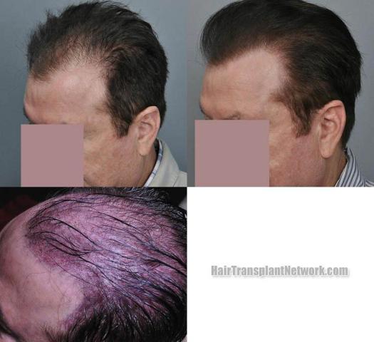 Hair transplantation surgery before and after pictures