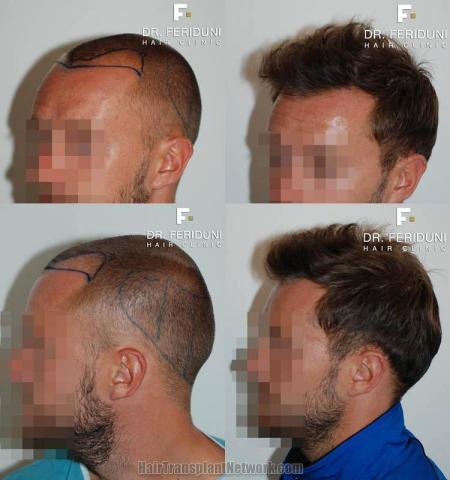 Hair transplantation surgery before and after photos