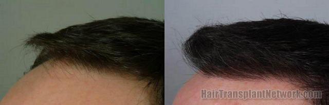 Viewing left side close up photos of hair transplant results