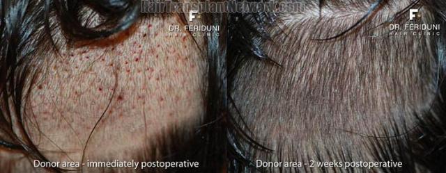 Hair transplantation surgery before and after pictures