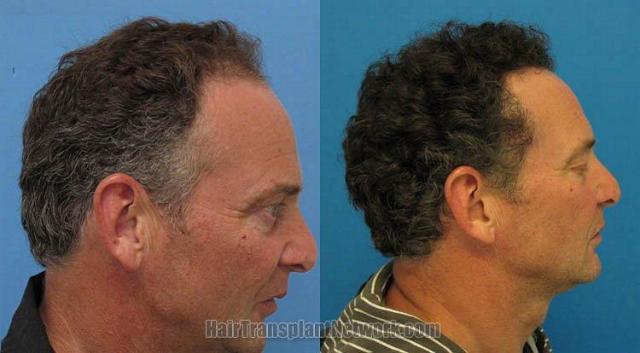 Hair restoration procedure results