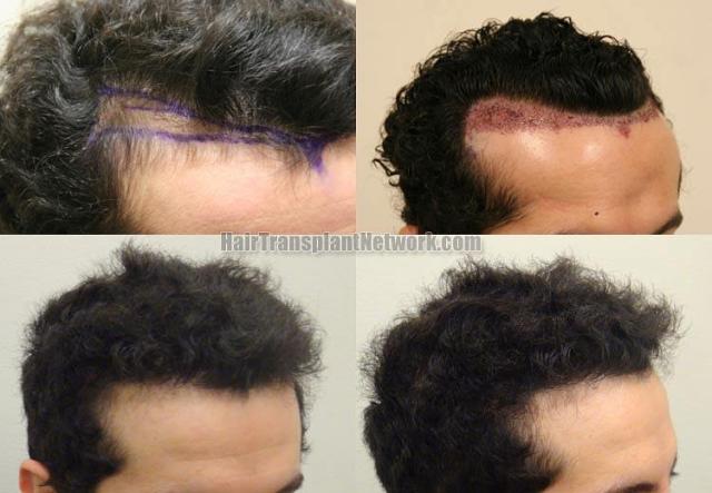 Hair restoration procedure before and after results