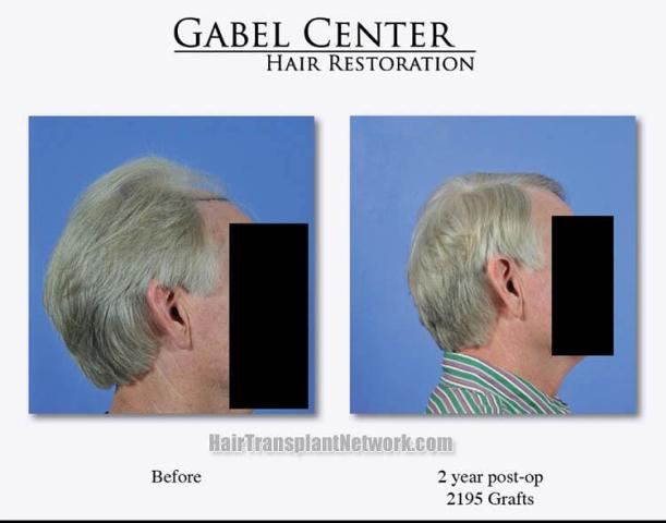 Before and after hair transplant procedure images