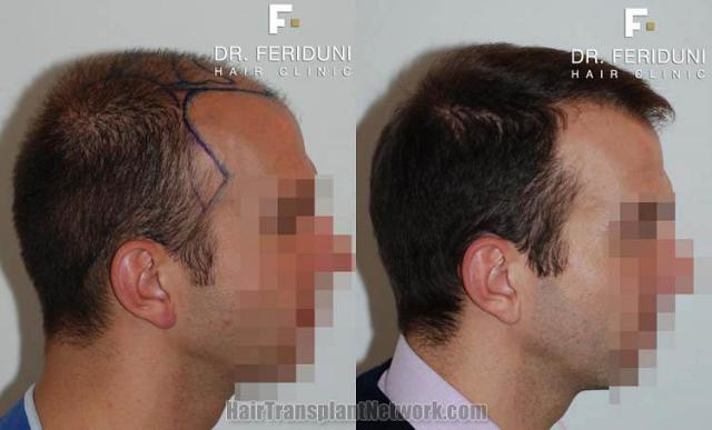 Hair restoration procedure before and after results