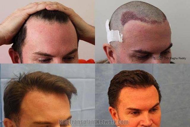 Hair transplantation surgery before and after images