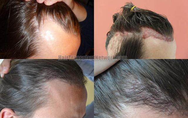 Hair transplantation surgery before and after images