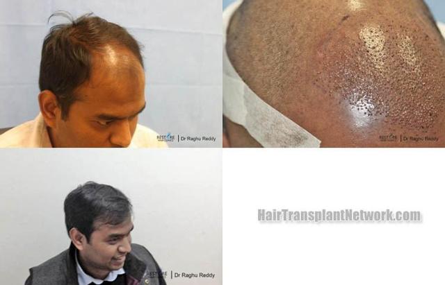 Hair transplantation surgery before and after images