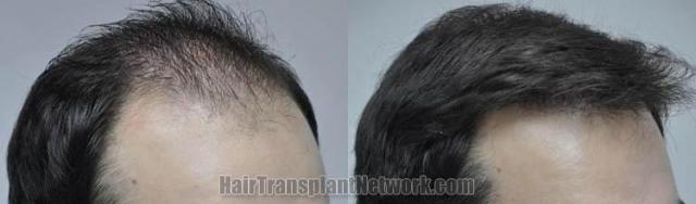 Hair restoration procedure before and after results