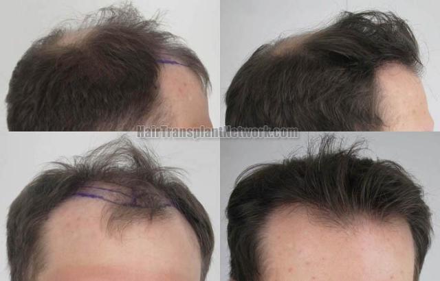 Hair transplantation surgery before and after images