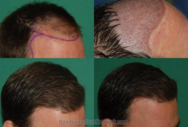 Hair transplantation surgery before and after images