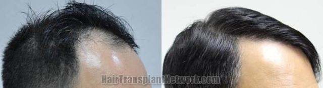 Hair transplantation surgery before and after pictures