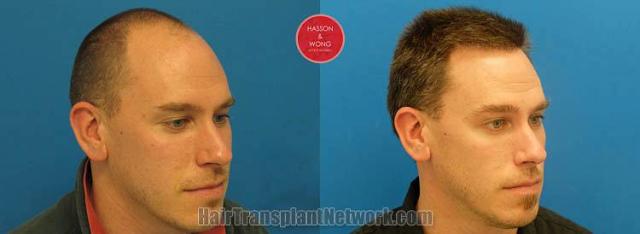 Hair transplantation surgery before and after images