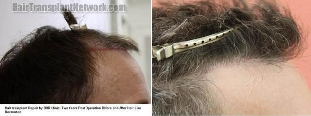 Hair transplantation surgery before and after images