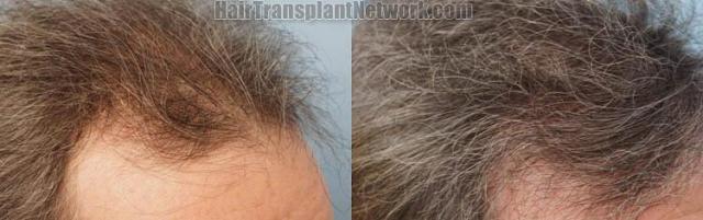 Hair transplantation surgery before and after photos