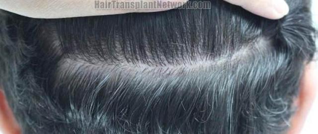 Hair restoration procedure before and after pictures