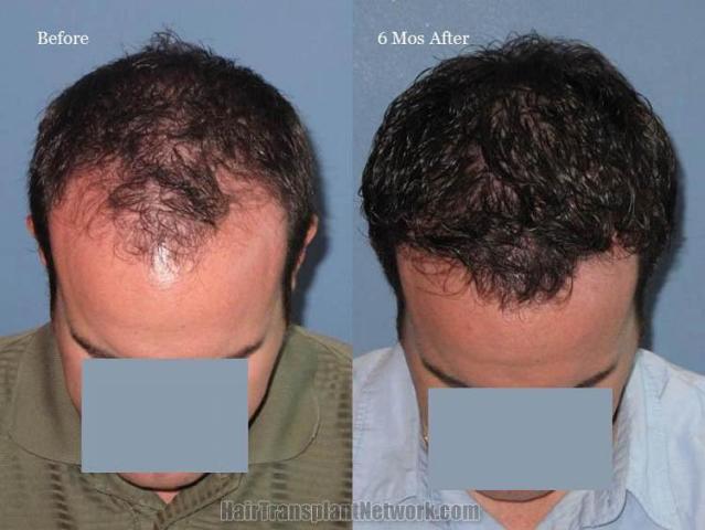 Hair transplantation surgery before and after photos