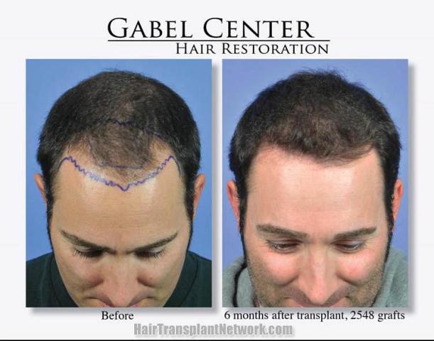 Hair transplantation surgery before and after photos