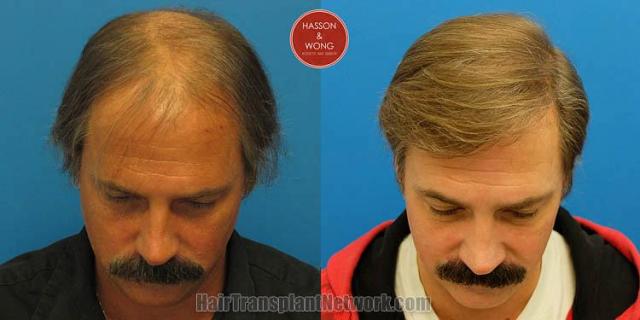 Hair restoration surgery before and after photos