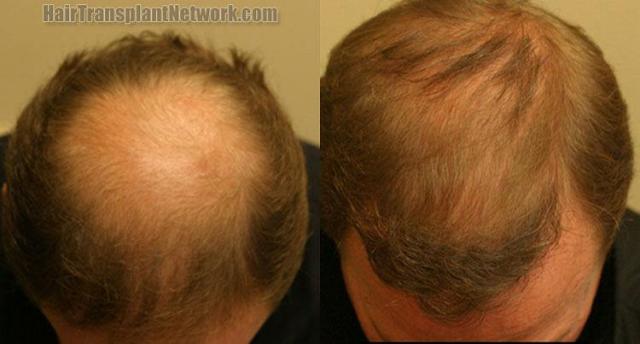 Top view - Before and after hair restoration photos