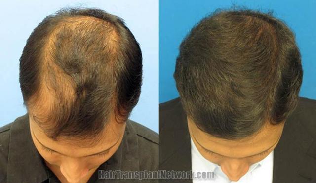 Top view before and after hair restoration results