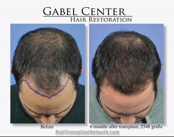 Top view - Before and after surgical hair replacement