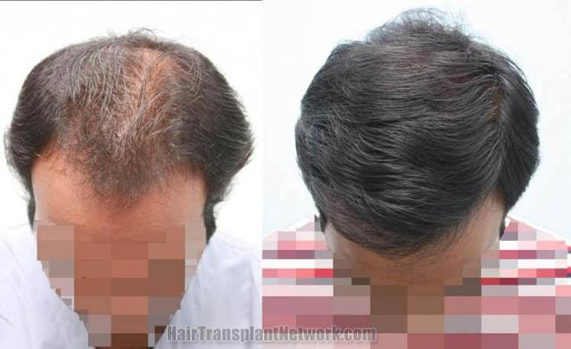 Hair restoration procedure before and after results