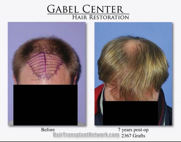 Top view before and after hair restoration results