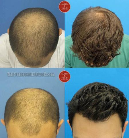 Hair transplantation surgery before and after photos