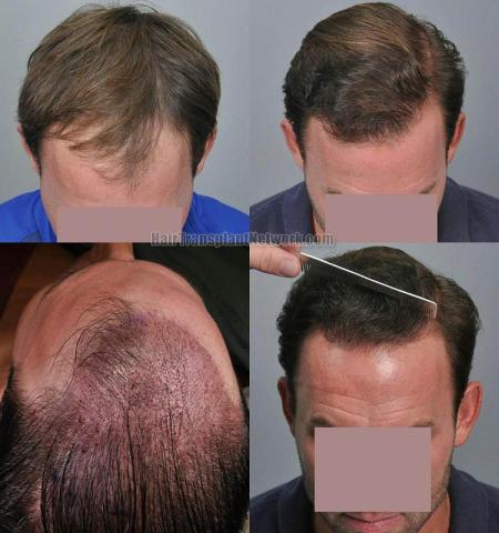 Top view before and after hair restoration results