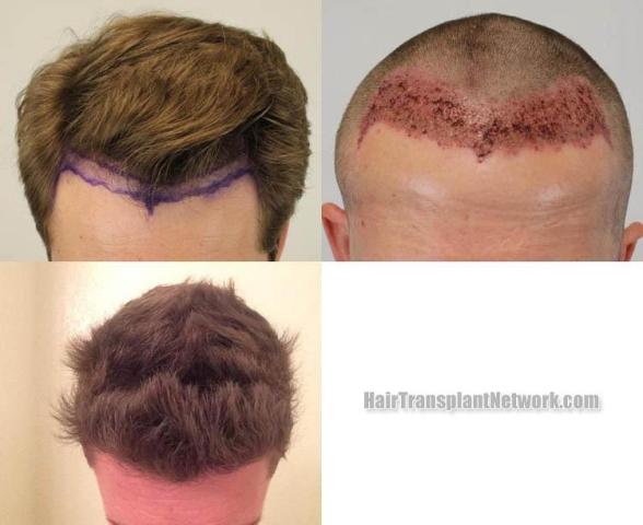 Top view before and after hair restoration results