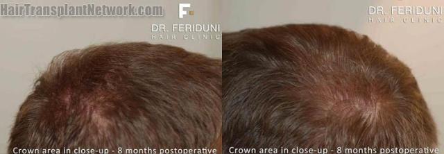 Hair replacement surgery before and after photographs