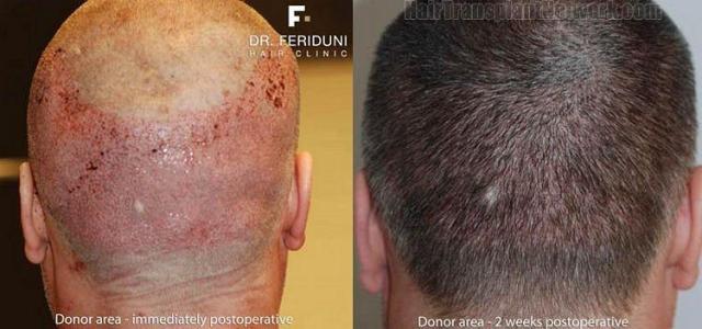 Donor area showing before and after hair transplant