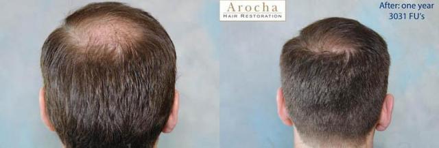 Back view before and after hair transplantation photos