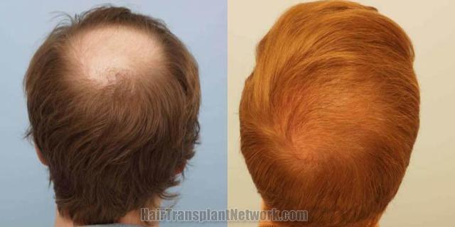 Hair restoration procedure before and after results