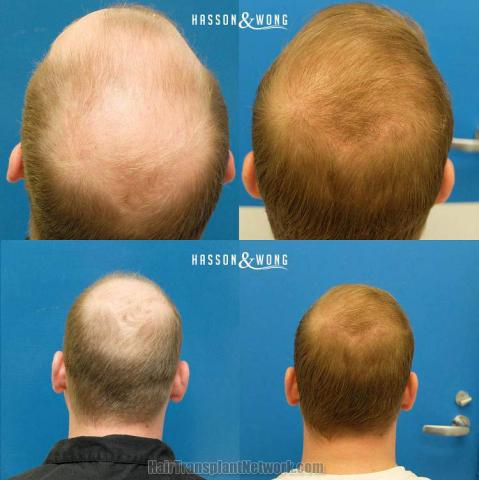 Hair transplantation surgery before and after images