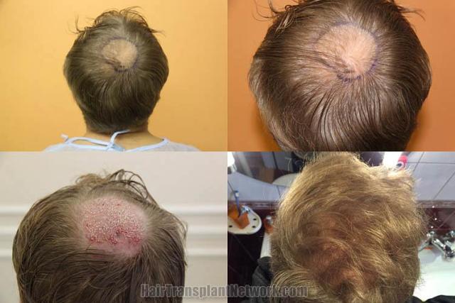 Hair restoration procedure before and after pictures