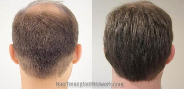 Hair restoration procedure before and after pictures